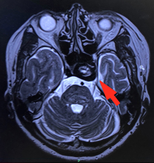 宇都宮記念病院の巨大脳動脈瘤の症例
